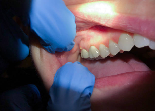 Best Emergency Treatment for Dental Infections or Abscesses in Bull Mountain, OR