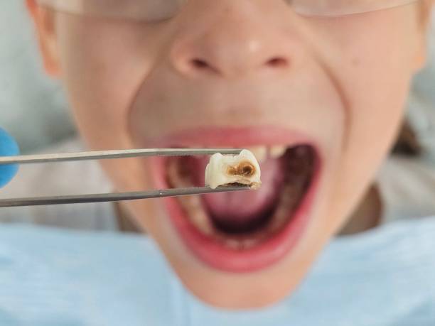 Best Emergency Treatment for Dental Infections or Abscesses in Bull Mountain, OR